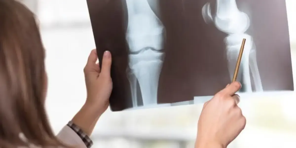 Ilustrasi osteoporosis