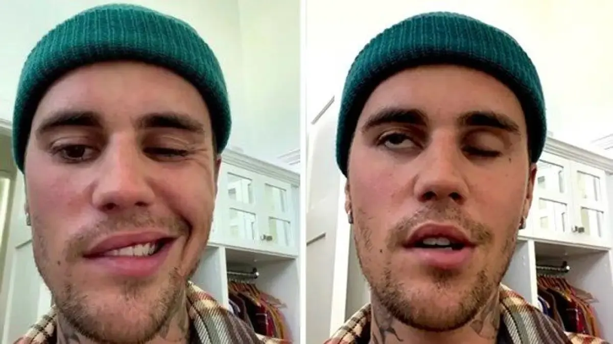 Justin Bieber terkena Ramsay Hunt Syndrome (Sumber : Instagram)