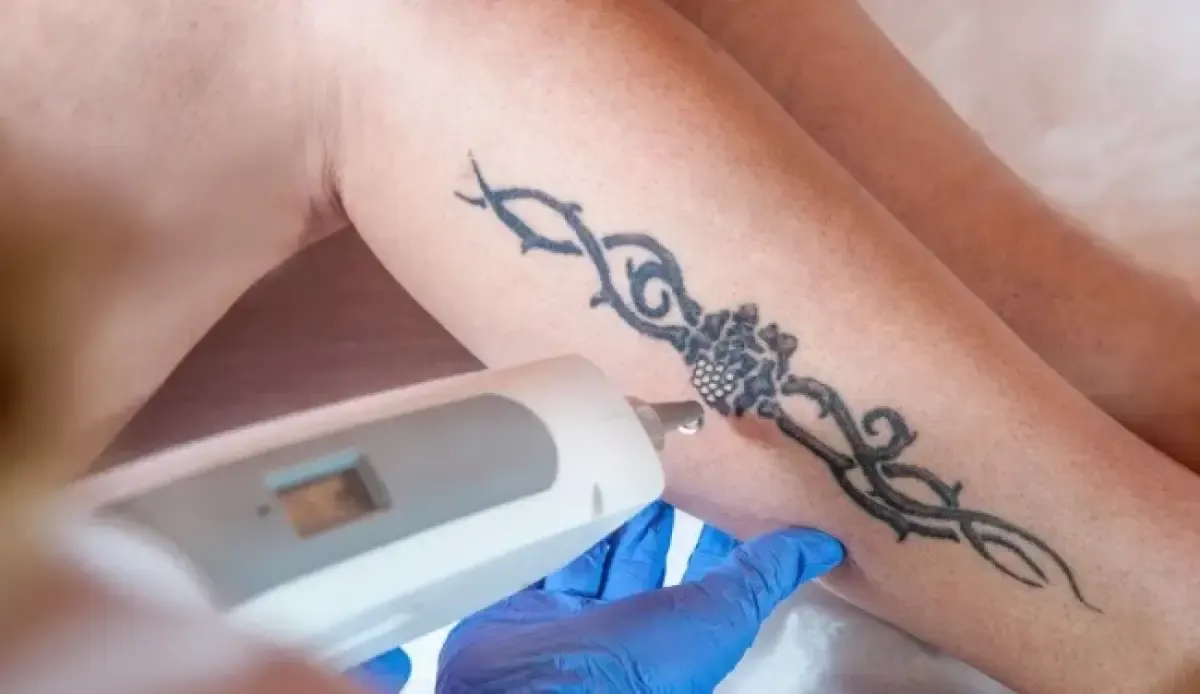 Cara menghapus tato yang aman menurut medis, jangan asal pilih! (Sumber : Hello Sehat)