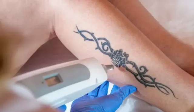 Jangan Asal, Ini 4 Cara Aman Hapus Tato Menurut Medis