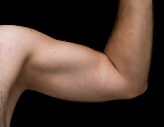 Tips Menghilangkan Stretch Mark, Harus Sabar dan Tepat Agar Kulit Tetap Sehat