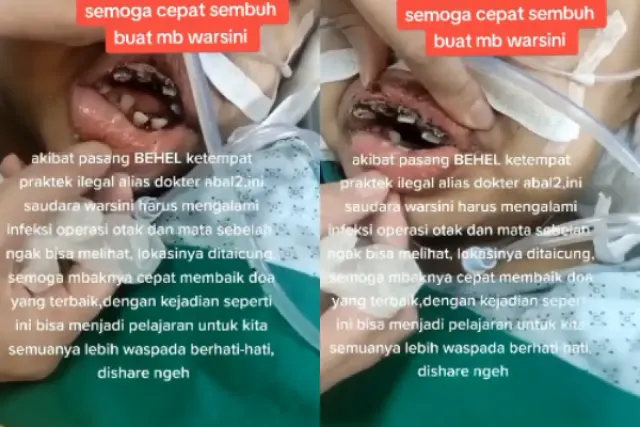 Miris! Pasal Behel di Klinik Abal-abal Taiwan, TKW Asal Madiun Malah Infeksi Otak