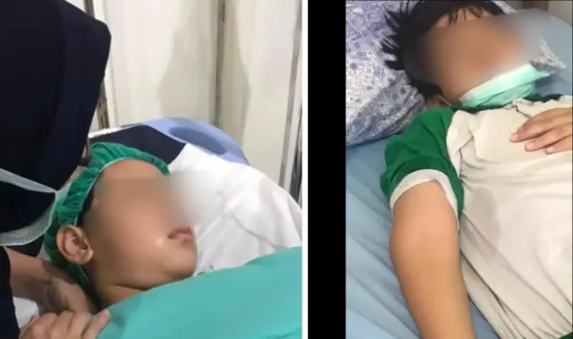 Sederet Penyiksaan yang Dialami Leon, Siswa SD di Sukabumi yang Dibully 15 Bulan hingga Patah Tulang