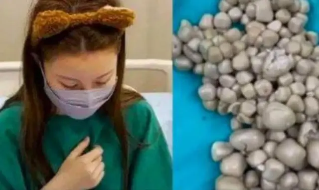 Ngeri! Dokter Temukan 300 Batu Ginjal di Tubuh Wanita Muda Gegara Jarag Minum Air Putih, Termasuk Bisa Sebabkan 7 Hal Lainnya Ini